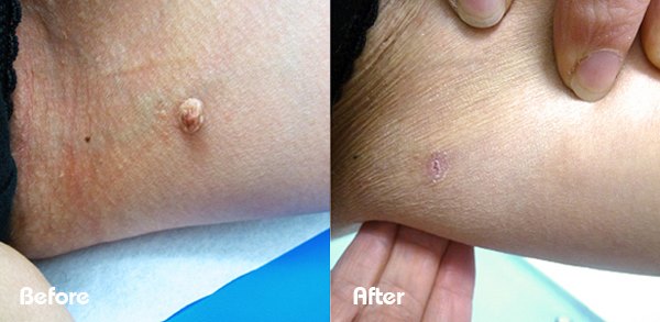 Skin tag before and after cryotherapy treatment — Beau Synergy Ltd
